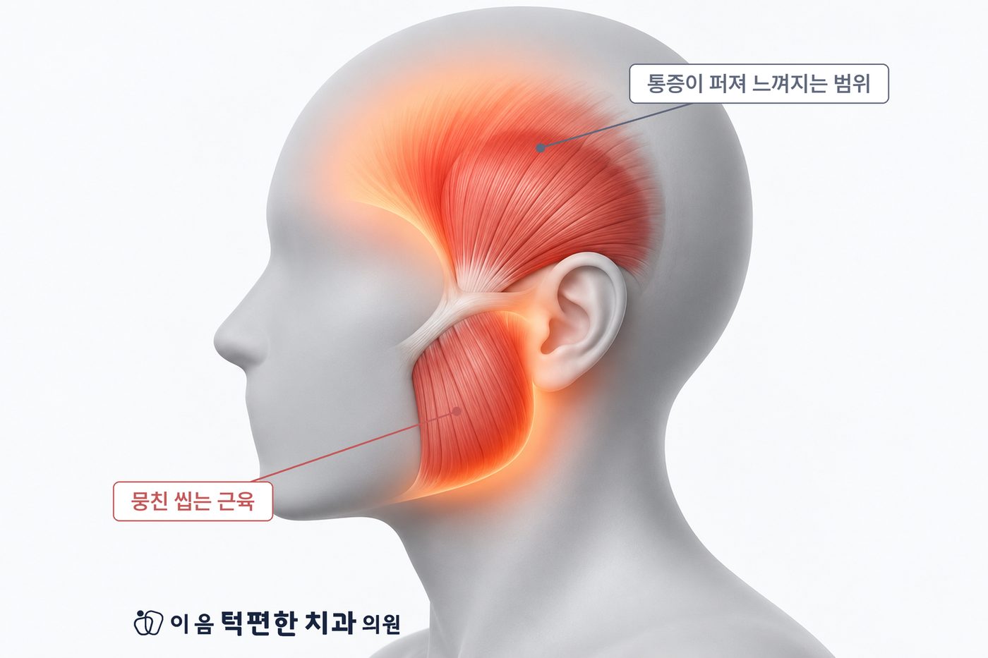 연관통 — 뭉친 씹는 근육의 통증이 관자놀이와 머리 옆으로 퍼지는 범위