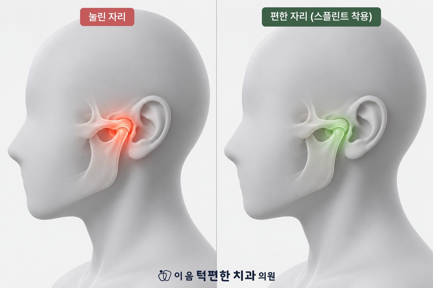 눌린 자리의 턱관절과 스플린트 착용으로 편해진 자리의 비교